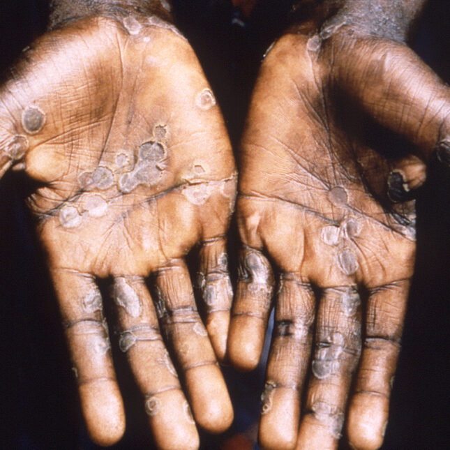 Monkeypox Treatment