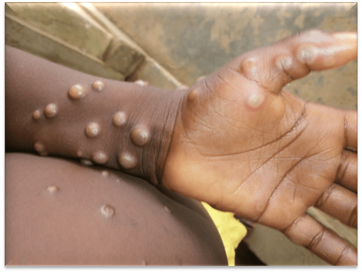 Monkeypox