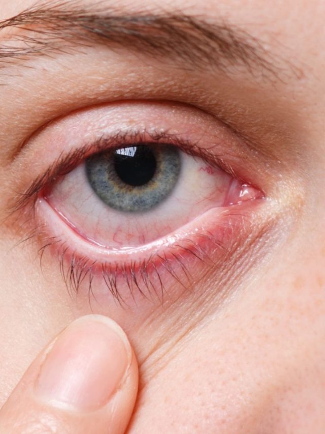 EYE FLU