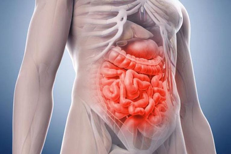 Crohn's disease